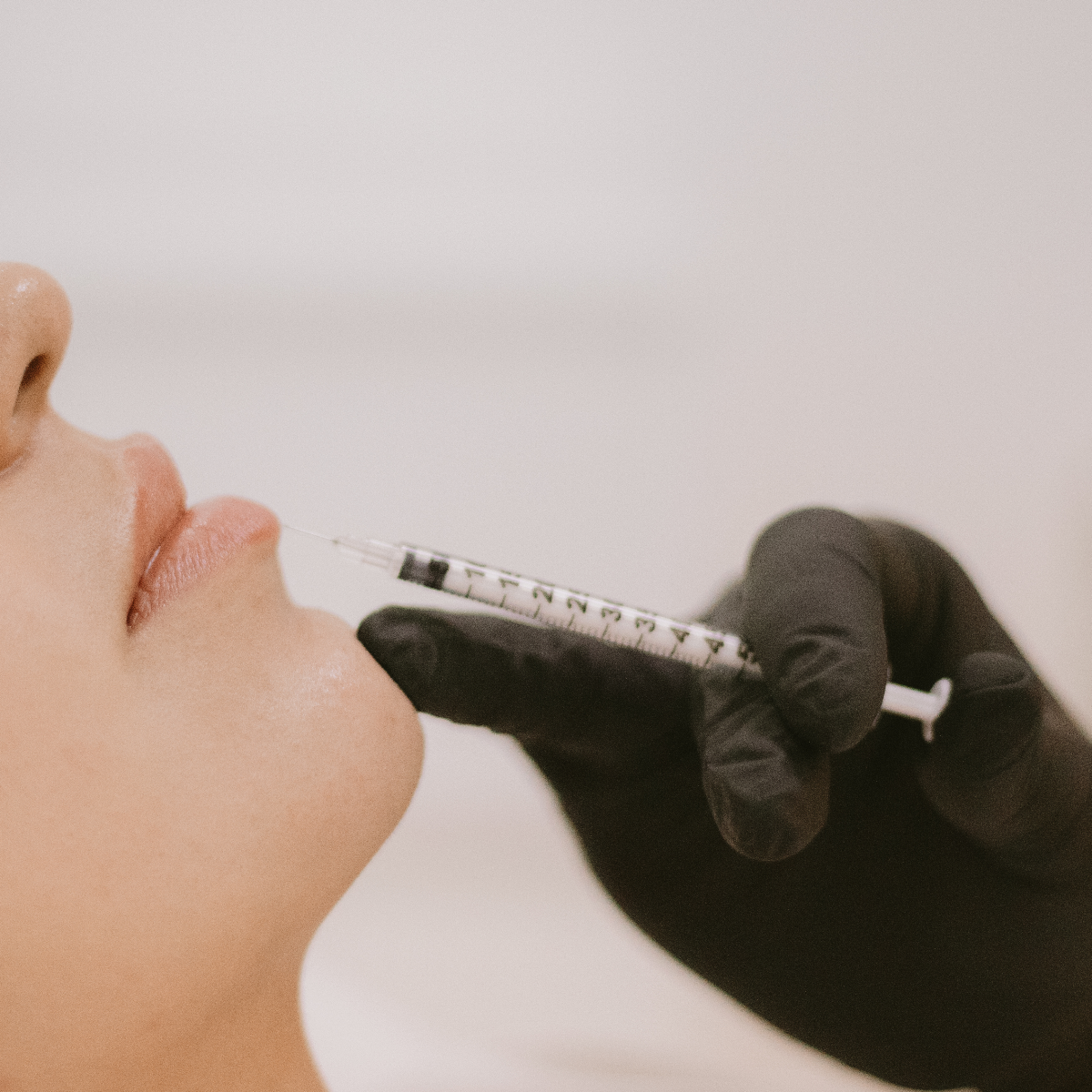 Lip Filler (Bioplastia Labial)