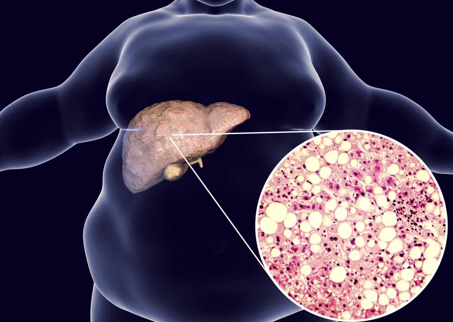 Penyebab Fatty Liver yang Sebenarnya, Bukan Hanya Lemak