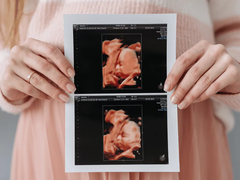 A mother holds and proudly displays a 4D ultrasound image, capturing her baby's detailed features in lifelike clarity