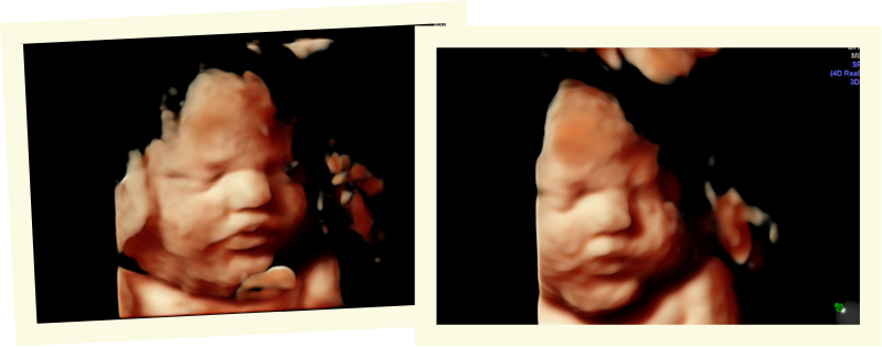 Side-by-side 4D ultrasound photos of a 33-week-old baby, highlighting detailed facial features in warm, lifelike imaging