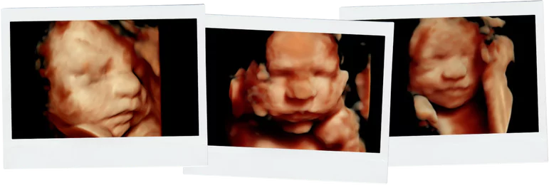Detailed 3D ultrasound image showing a baby’s face and hand, showcasing the clarity and detail available through advanced imaging.