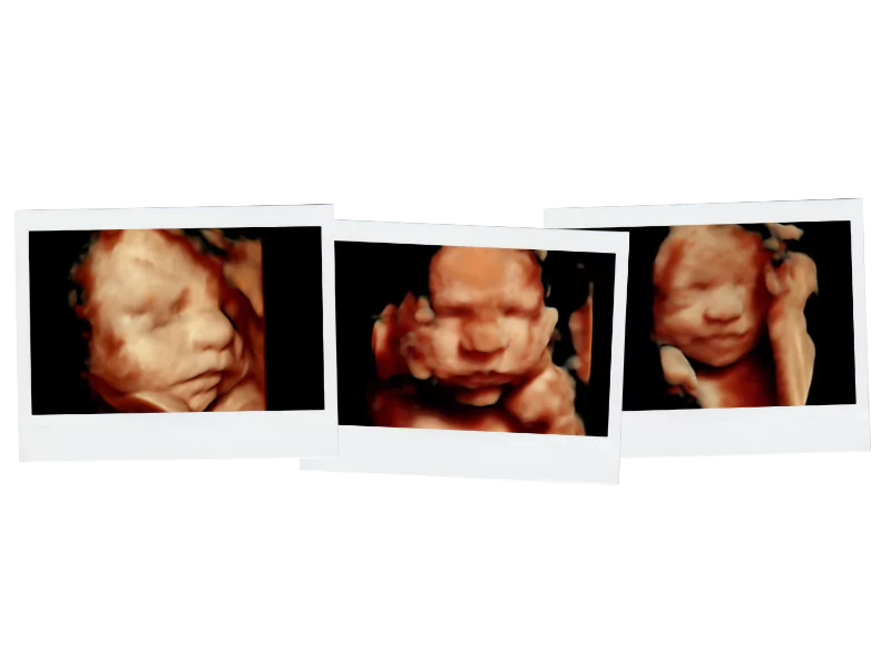 Three sample images of 4D ultrasound scans showcasing lifelike details of a baby’s face and expressions before birth.