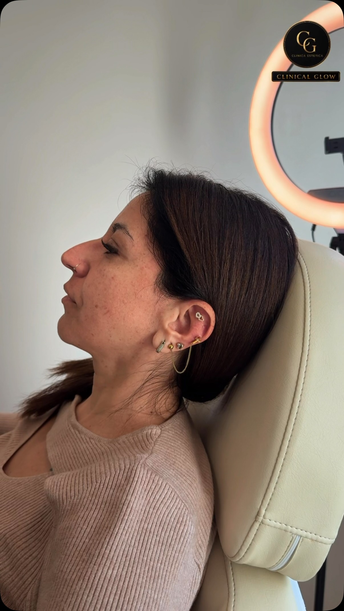 ✨ Un nuevo perfil, una nueva confianza ✨

Acompáñanos en este proceso de transformación en Clinical Glow 🤍
Cada detalle cuenta para lograr una armonía facial única, empieza tu glow up acá! 

📲 Agenda tu evaluación y comienza tu glow up con nosotros!

#ClinicalGlow #Rinomodelacion #AcidoHialuronico #ArmoniaFacial #MedicinaEstetica en Clinical Glow · Clínica Estética, Viña del Mar