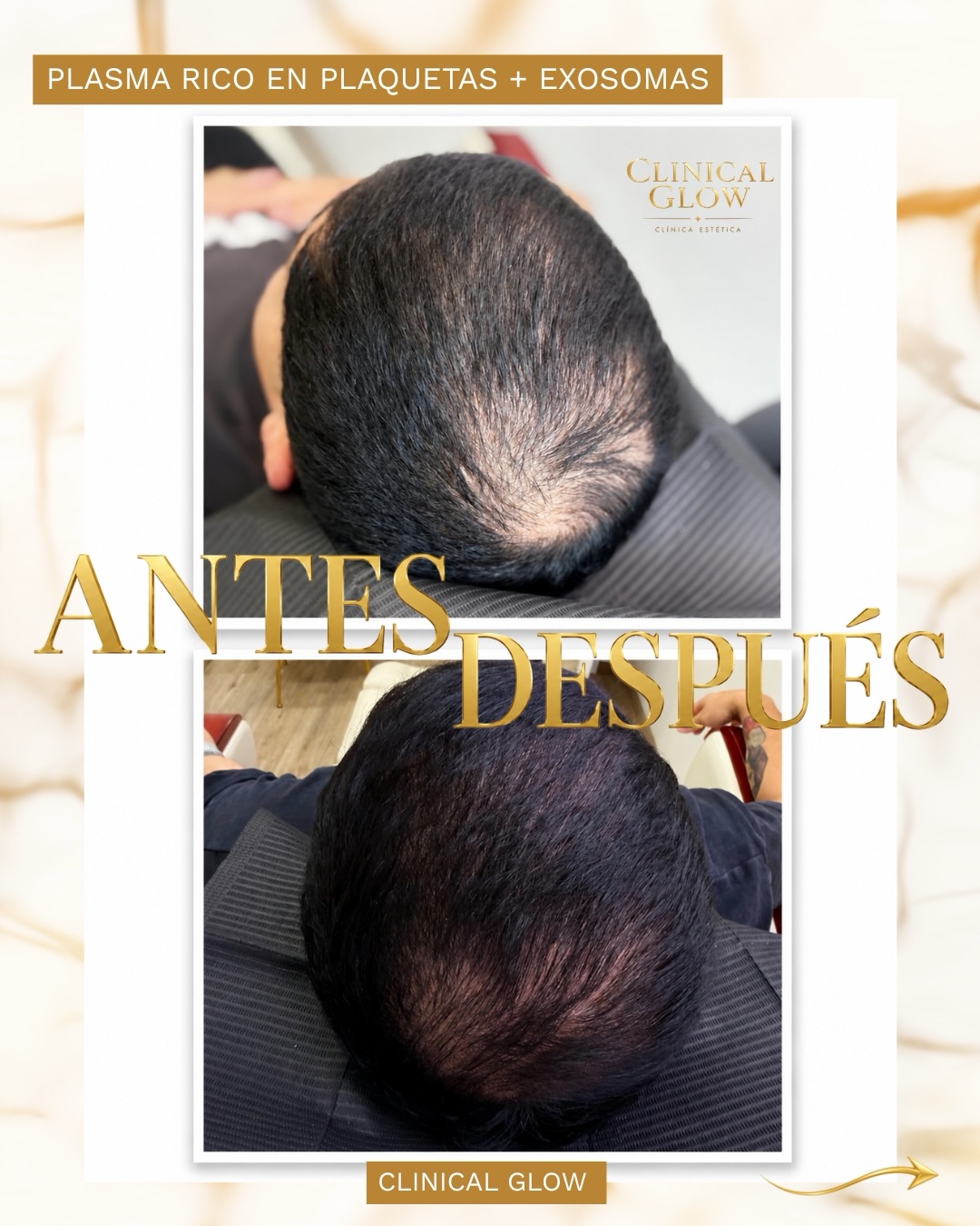 ✨ Renueva tu imagen, potencia tu confianza como lo hizo @sebastianpaul___ ✨

El cambio comienza con el cuidado adecuado. En Clinical Glow realizamos tratamientos avanzados como Plasma Rico en Plaquetas + Exosomas, una combinación enfocada en estimular la regeneración y mejorar la calidad del cuero cabelludo. 🧬✨

Cada proceso es evaluado de manera personalizada para acompañarte en el camino hacia un cabello con mayor vitalidad y apariencia saludable.

📲 Agenda tu evaluación en Clinical Glow y descubre el tratamiento ideal para ti.
💛 Tu mejor versión comienza con el primer paso.

#ClinicalGlow #PlasmaRicoEnPlaquetas #Exosomas #SaludCapilar #MedicinaEstética en Clinical Glow · Clínica Estética, Viña del Mar
