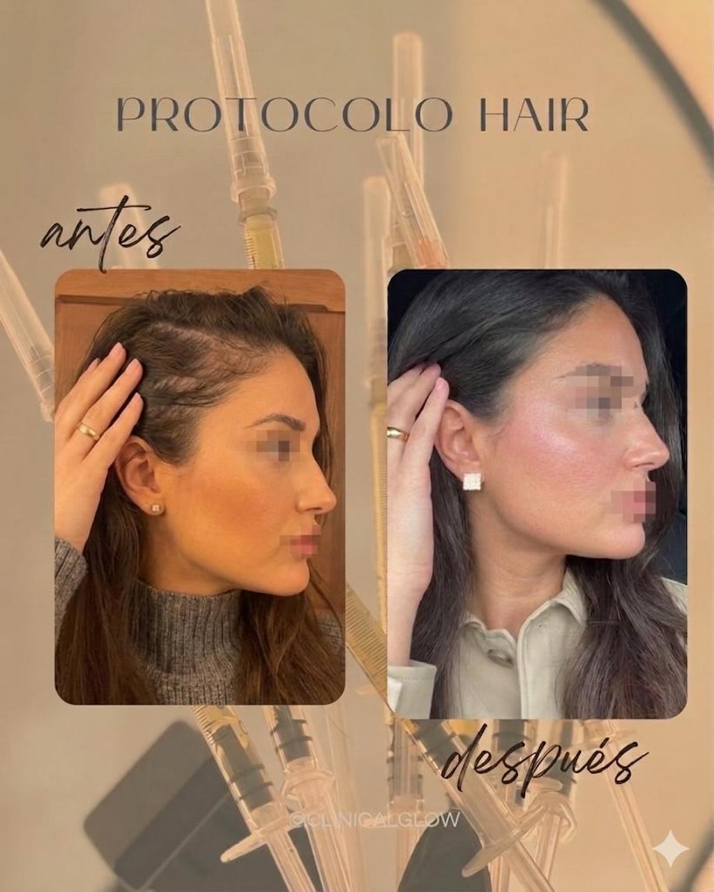 ✨ ANTES Y DESPUÉS | PROTOCOLO HAIR ✨

Resultados reales que hablan por sí solos 🤍

📸 Imagen 1: Día 0, previo al tratamiento.
📸 Imagen 2: 5 semanas después de su última sesión de PROTOCOLO HAIR (Exosomas + PRP).

Este protocolo está diseñado para estimular el folículo piloso, fortalecer el cabello existente y favorecer el crecimiento de nuevo cabello, mejorando progresivamente la densidad capilar.

✅Lo importante de la adherencia al tratamiento.

📍Agenda tu evaluación gratuita en Clinical Glow y descubre cuál es el mejor plan para recuperar la salud de tu cabello.

#ExosomasCapilares #PRP #RegeneraciónCapilar #Alopecia  #CaídaDelCabello en Clinical Glow · Clínica Estética, Viña del Mar