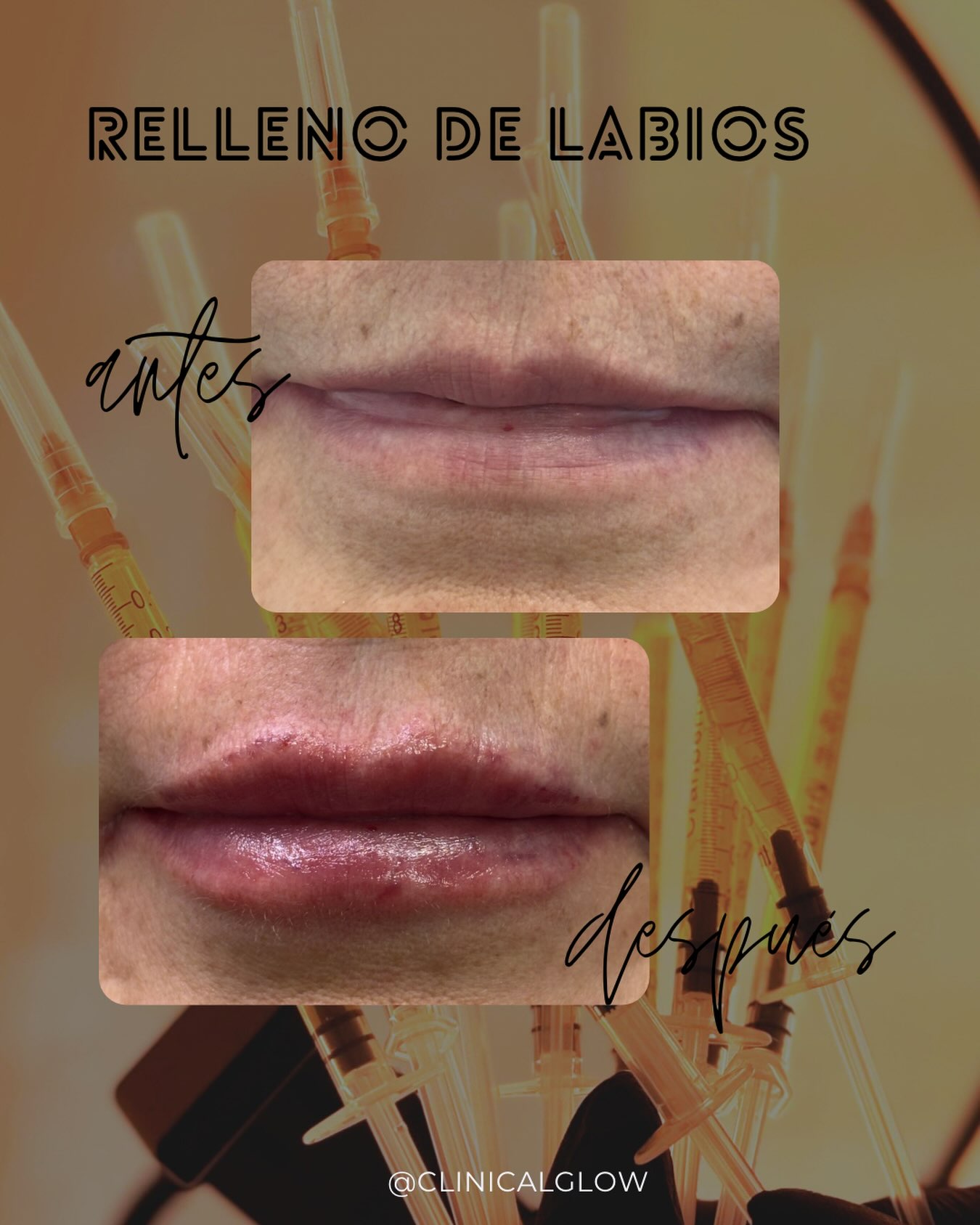 ✨ Antes y después | Perfilado y aumento de labios 💋

Resultados naturales, armónicos y personalizados, respetando la anatomía y los deseos de cada paciente. 🤍

💉 Ácido hialurónico reticulado
✨ Más hidratación, definición y armonía facial.

📍 Clinical Glow | Viña del Mar

Resultados pueden variar según cada paciente y evaluación profesional.
#ClinicalGlow #AcidoHialuronico #Labios #MedicinaEstetica #AntesYDespues en Clinical Glow · Clínica Estética, Viña del Mar