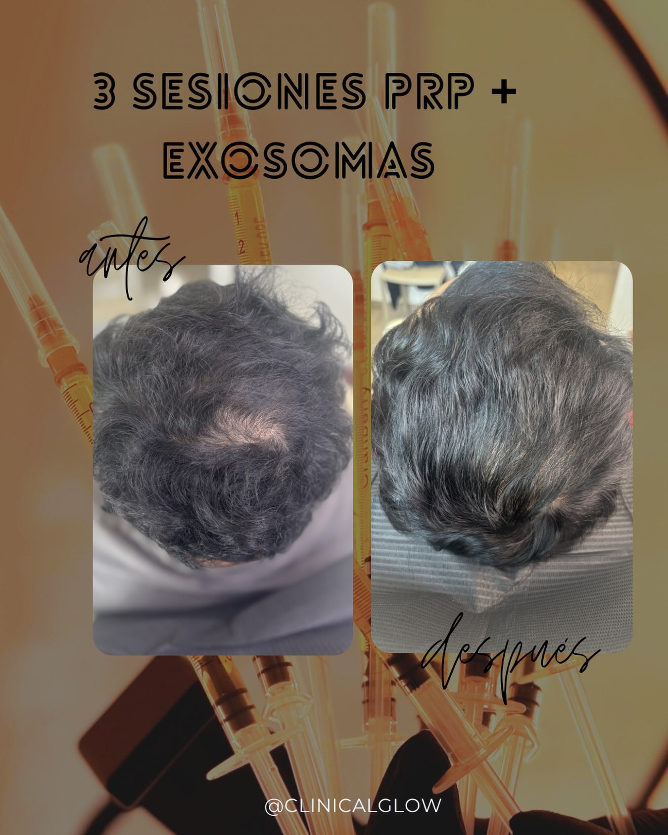 ✨ PRP + Exosomas Capilares

Resultados progresivos: 

• 2–4 semanas: disminuye la caída.
• 6–8 semanas: el cabello comienza a fortalecerse.
• 3–4 meses: mayor densidad, grosor y calidad capilar.
• 5–6 meses: se alcanza el máximo efecto del protocolo inicial.

💉 Recomendación: 3 sesiones y luego 1 sesión de mantenimiento cada 4–6 meses para prolongar los resultados.

#PRPCapilar #Exosomas #SaludCapilar #ClinicalGlow #ViñaDelMar en Clinical Glow · Clínica Estética, Viña del Mar