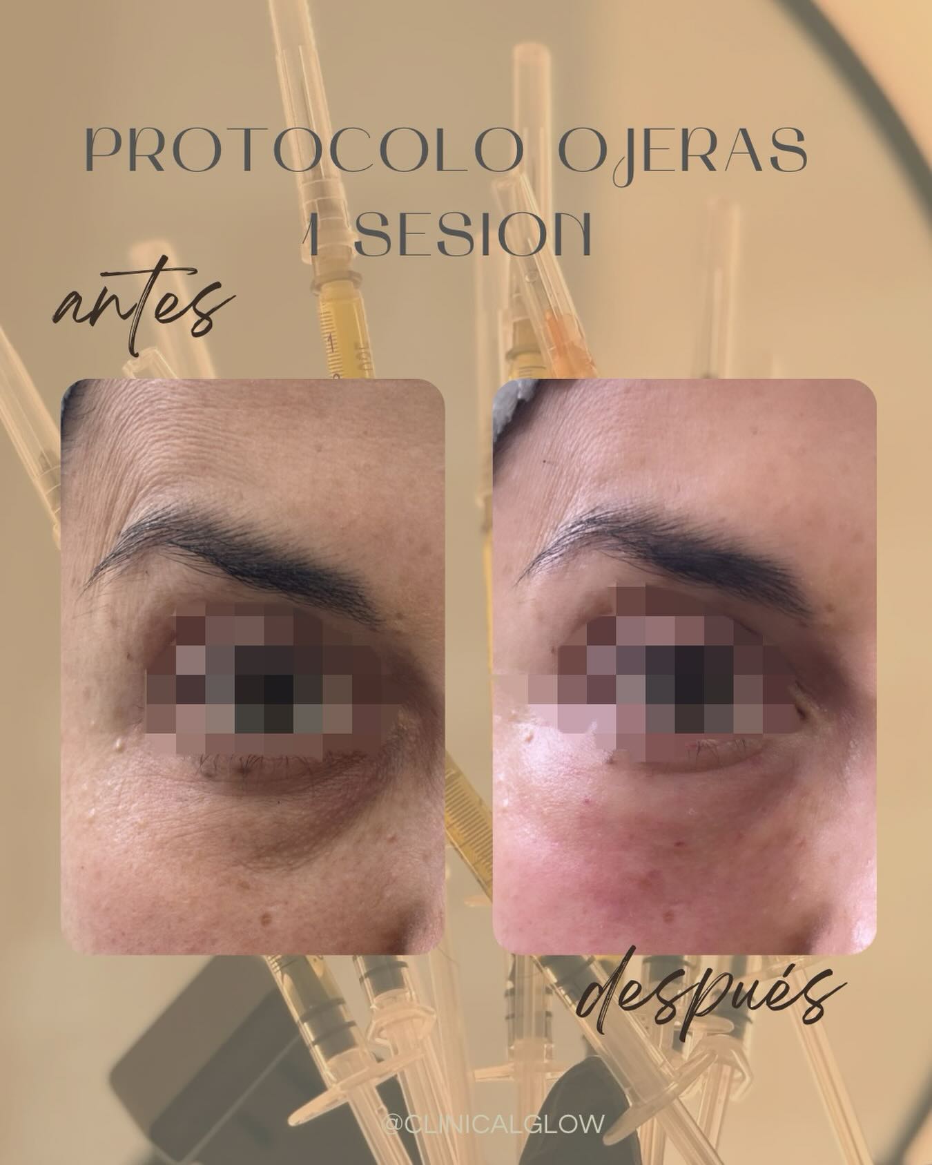 Caso clínico en su sesión 1.

Nuestro protocolo para ojeras contempla 4 sesiones, utilizando diferentes activos en cada etapa del tratamiento para abordar de manera integral la pigmentación, calidad de la piel y signos de fatiga en la zona periocular.

En estas imágenes se observa el resultado posterior a la primera sesión. A pesar de la inflamación transitoria propia de la intervención mediante micropunciones, ya es posible evidenciar una mejora significativa en la apariencia de las ojeras y en la calidad general de la piel.

Cada paciente requiere una evaluación personalizada para determinar el protocolo más adecuado según sus necesidades.

Clinical Glow ✨ en Clinical Glow · Clínica Estética, Viña del Mar