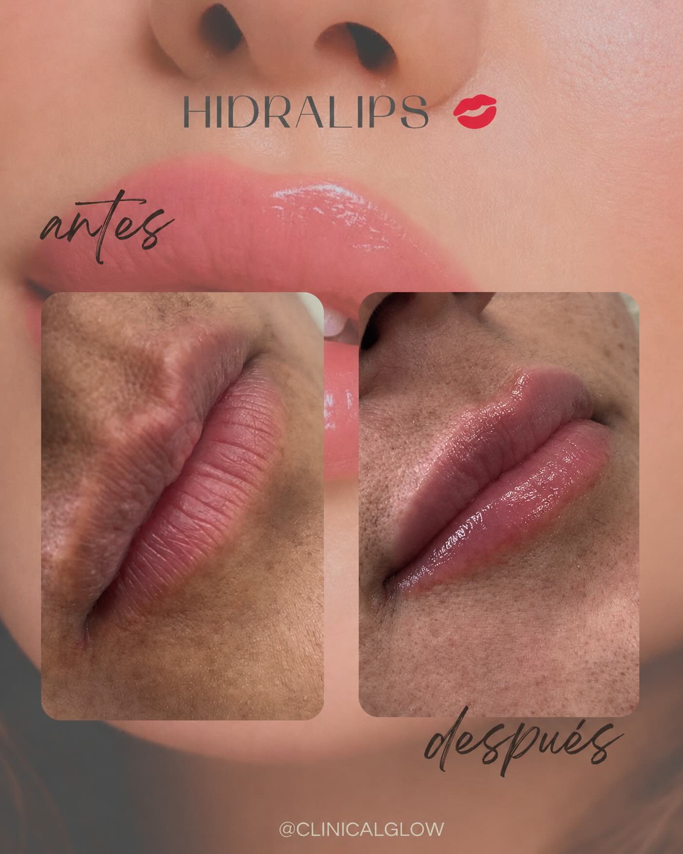 Hidratación, textura y mejora en la apariencia general de los labios, logrando un resultado natural y saludable.

📍 Procedimiento mínimamente invasivo.
💧 Ideal para labios resecos, opacos o con líneas finas.
✨ Resultado natural, sin aumentar exageradamente el volumen.

#Hidralips #HidrataciónLabial #LabiosSaludables  #MedicinaEstética #ClinicalGlow en Clinical Glow · Clínica Estética, Viña del Mar