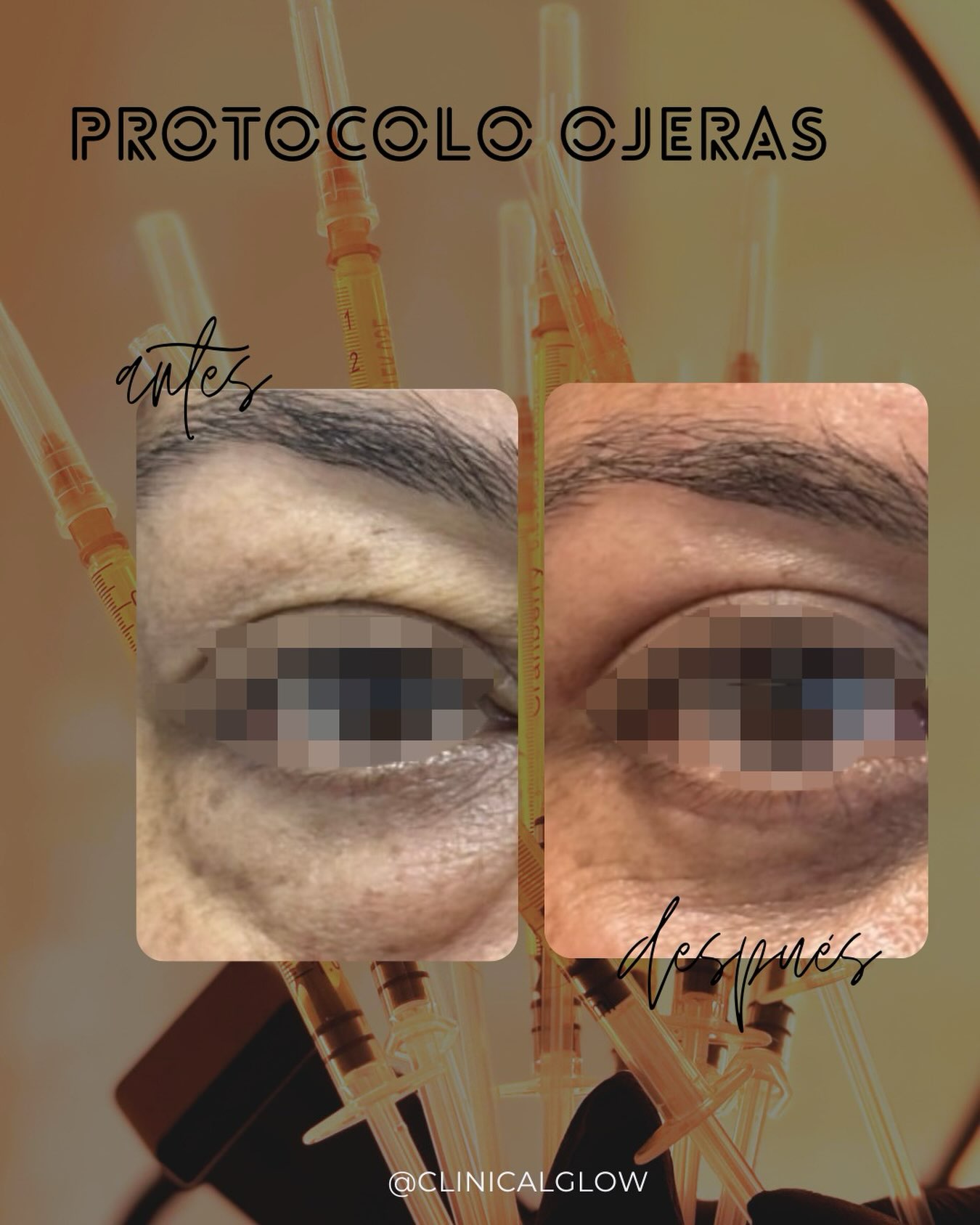 Cambio en proceso 📈 en Clinical Glow · Clínica Estética, Viña del Mar