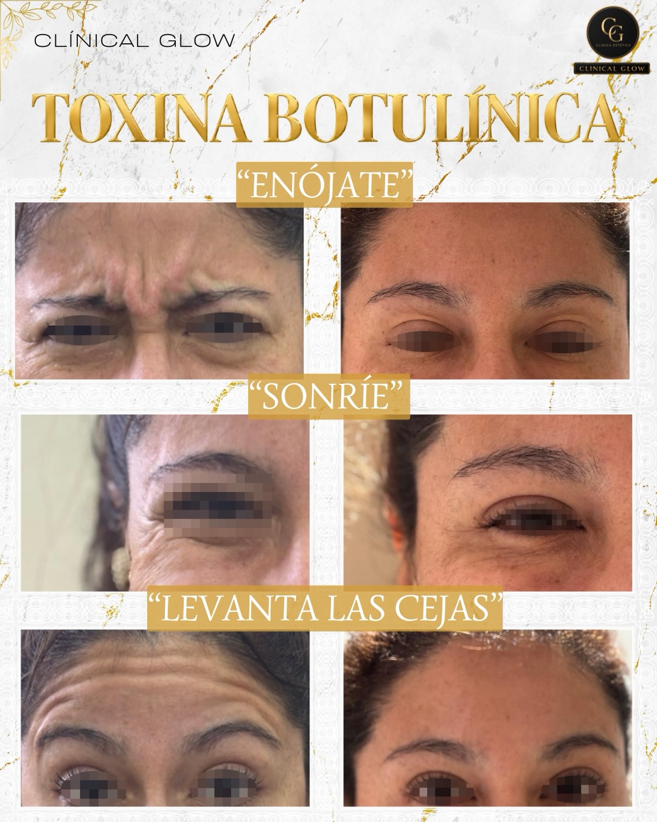 Sé tú, pero con una expresión más armónica y descansada ✨

Menos líneas de expresión, sin perder la naturalidad de tu rostro.

#ToxinaBotulínica #EstéticaFacial #ClinicalGlow #BellezaNatural en Clinical Glow · Clínica Estética, Viña del Mar