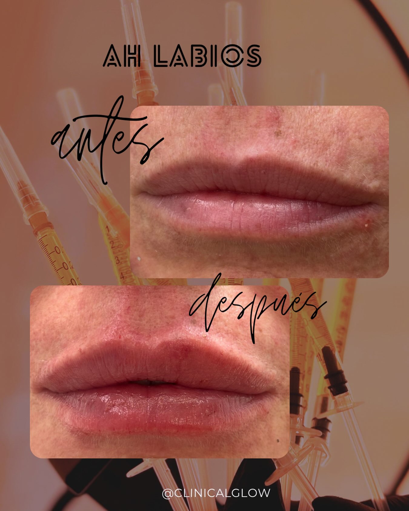 Resultados que realzan tu belleza. 💋

Se logró lo que ella quería y mejoramos simetría. 

Con ácido hialurónico logramos labios más hidratados, definidos y con un volumen armónico, respetando siempre la esencia de CADA paciente.

📍Clinical Glow | Viña del Mar

#AcidoHialuronico #RellenoLabial #MedicinaEstetica #ClinicalGlow AntesYDespues en Clinical Glow · Clínica Estética, Viña del Mar