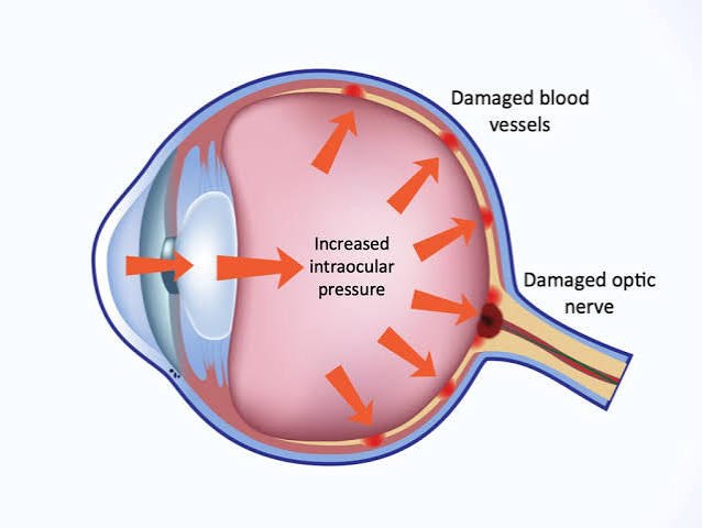 Pediatric Glaucoma Management