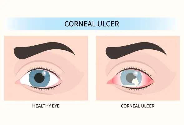 Corneal Ulcer & Infection Care