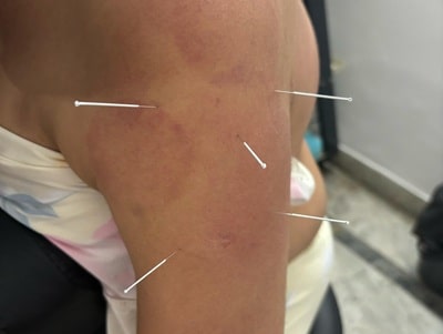 Dry Needling