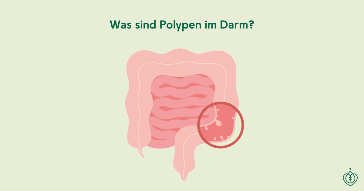 was sind darmpolypen