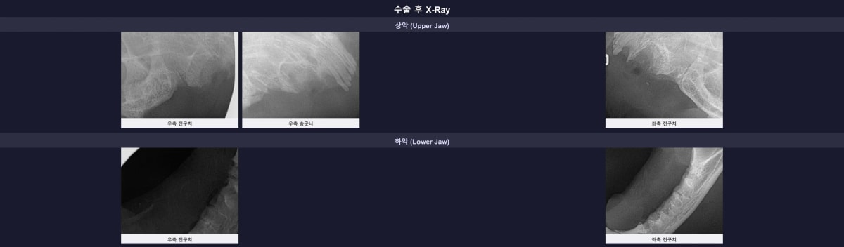 수술 후 필드의 구강 방사선 엑스레이 - 잔존 치근 없이 깔끔하게 발치된 모습