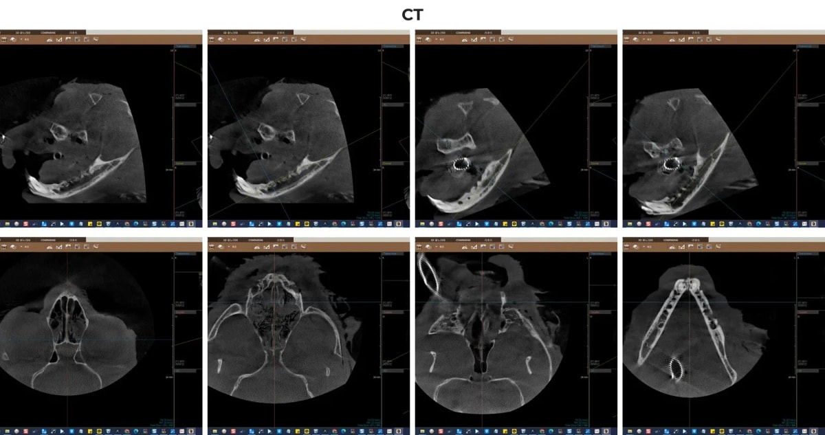 치과 전용 CT를 통해 필드의 치주 질환 및 잇몸뼈 상태를 분석하는 화면