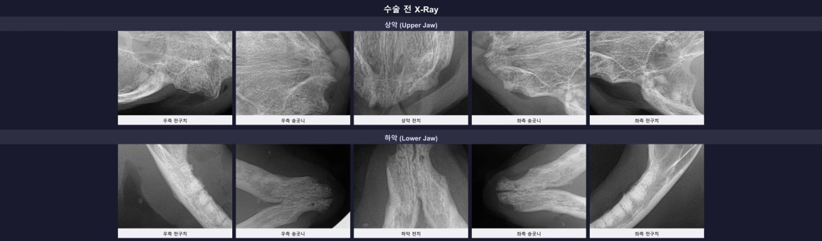 수술 전 구강 엑스레이에서 다수의 위치에 부러진 치아 뿌리(잔존 치근)가 남아있는 모습