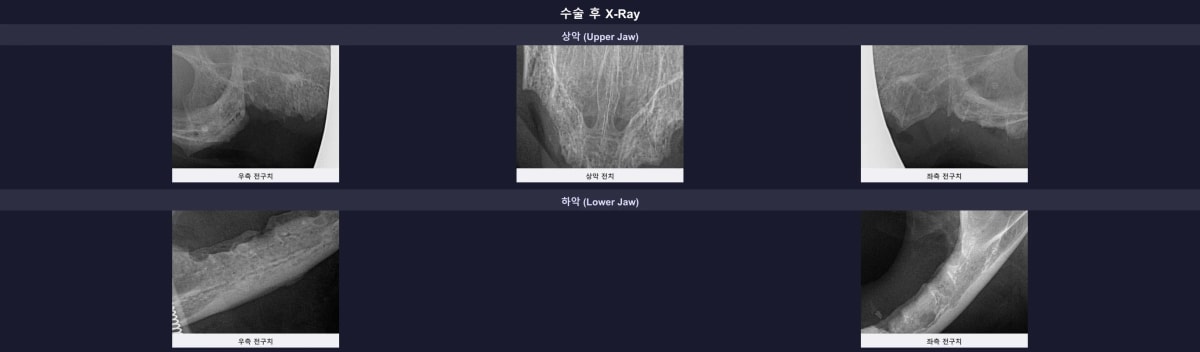 수술 후 엑스레이에서 잔존 치근이 완벽하게 제거된 것을 확인하는 모습