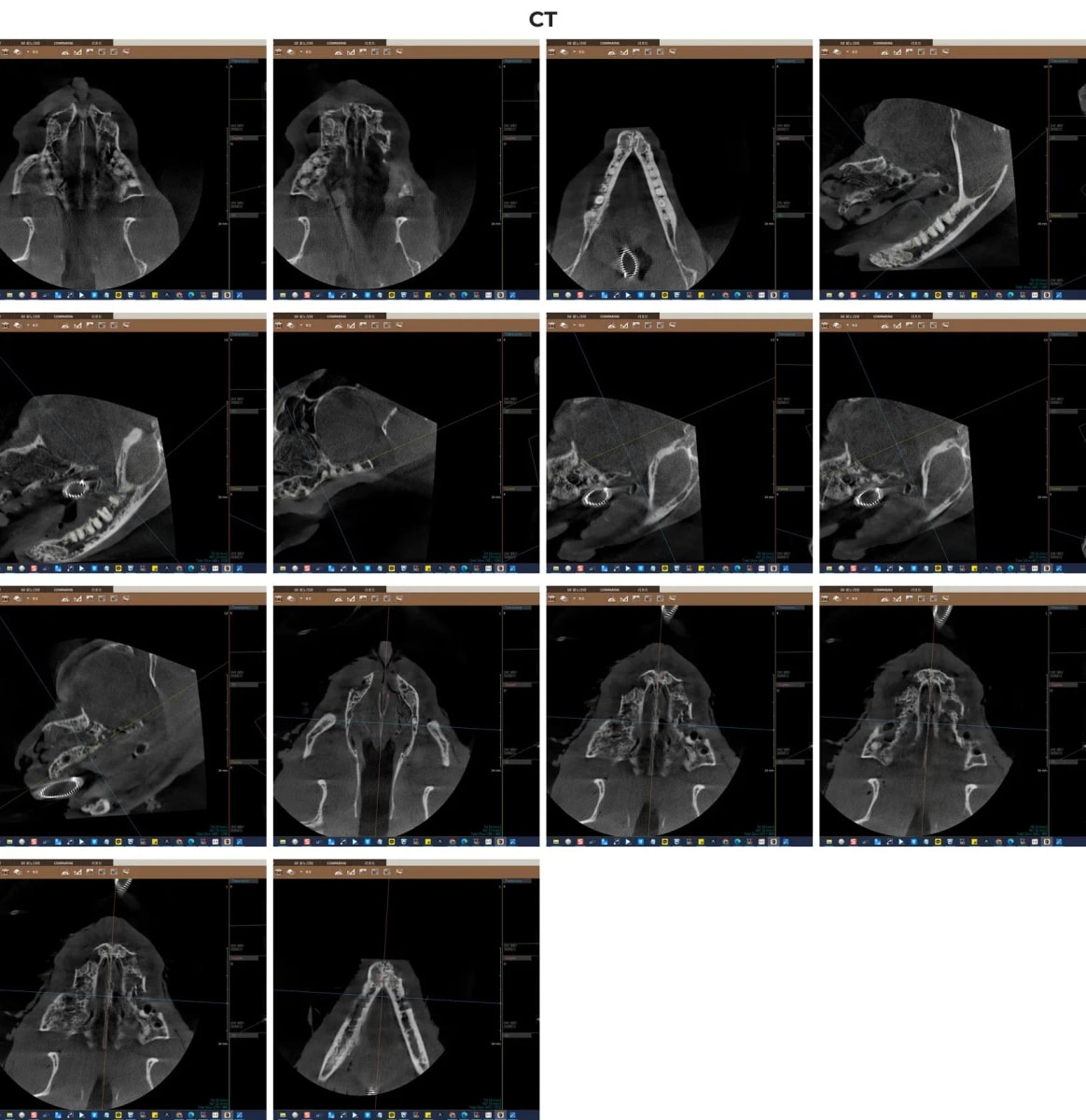 치과 CT를 통해 잇몸뼈 속에 숨겨진 잔존 치근의 3차원적 위치를 파악하는 영상 소견