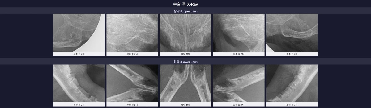 잔존 치근 없이 깨끗하게 전발치가 완료된 수술 후 구강 엑스레이 영상