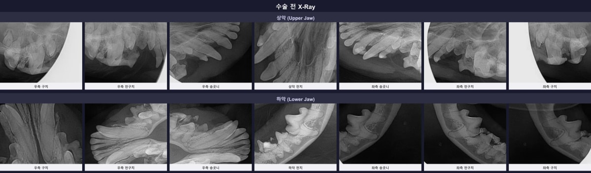 수술 전 치과 방사선 검사에서 확인된 잇몸 증식과 치아 뿌리 염증 소견