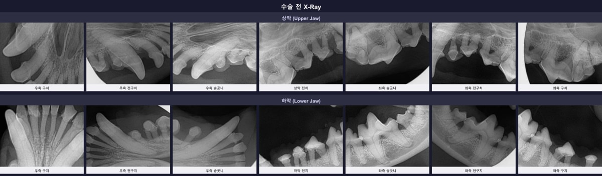 수술 전 구강 엑스레이에서 관찰되는 중증 치주염과 치조골 흡수 소견