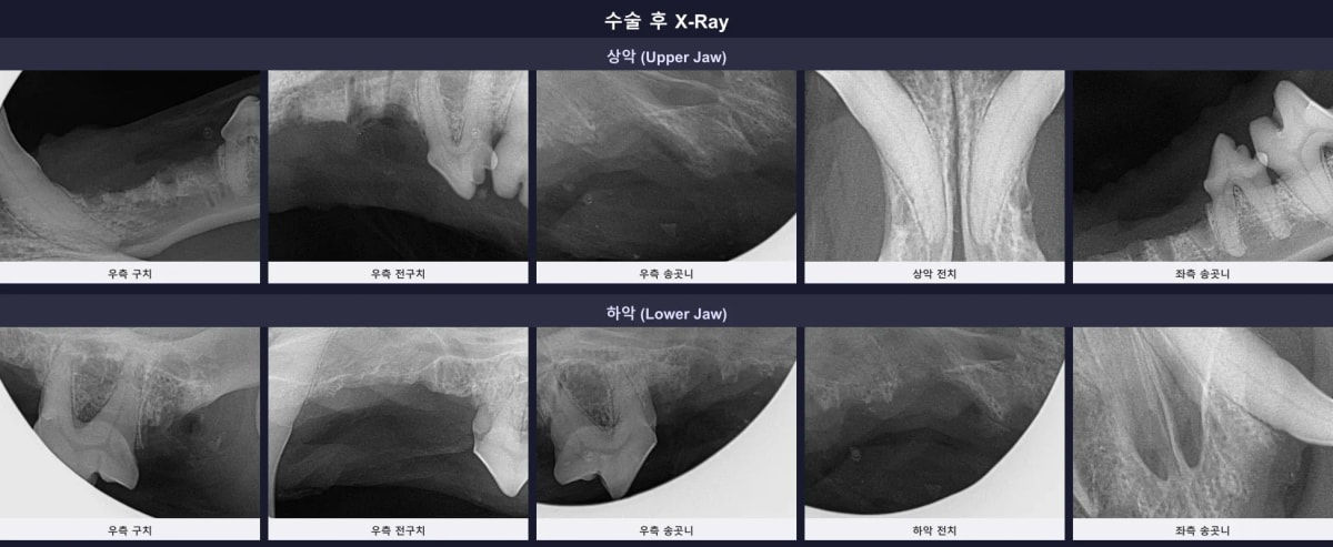 수술 후 잔존 뿌리 없이 깨끗하게 마무리된 구강 엑스레이 소견