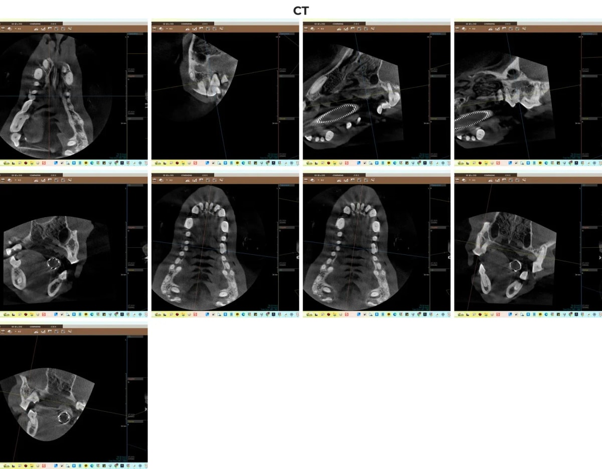 광주 전남 유일 치과 CT를 통한 행복이의 치조골 흡수 진단 영상