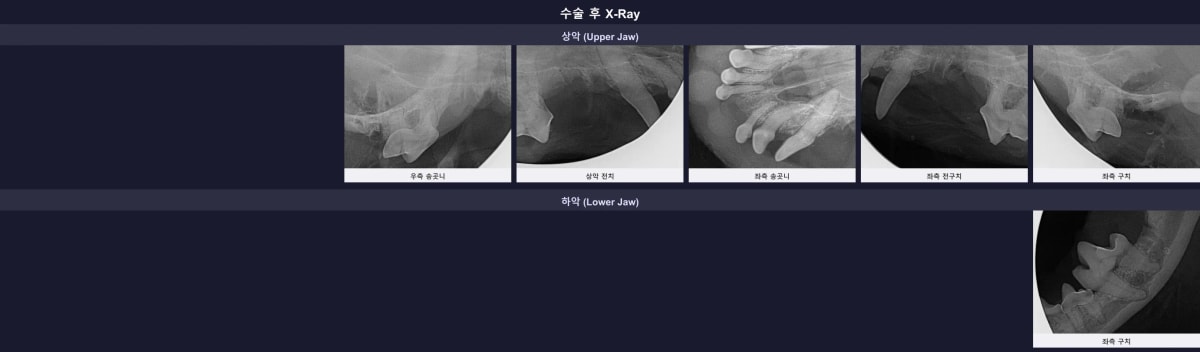 수술 후 잔존 뿌리 없이 깔끔하게 발치된 치과 방사선 사진