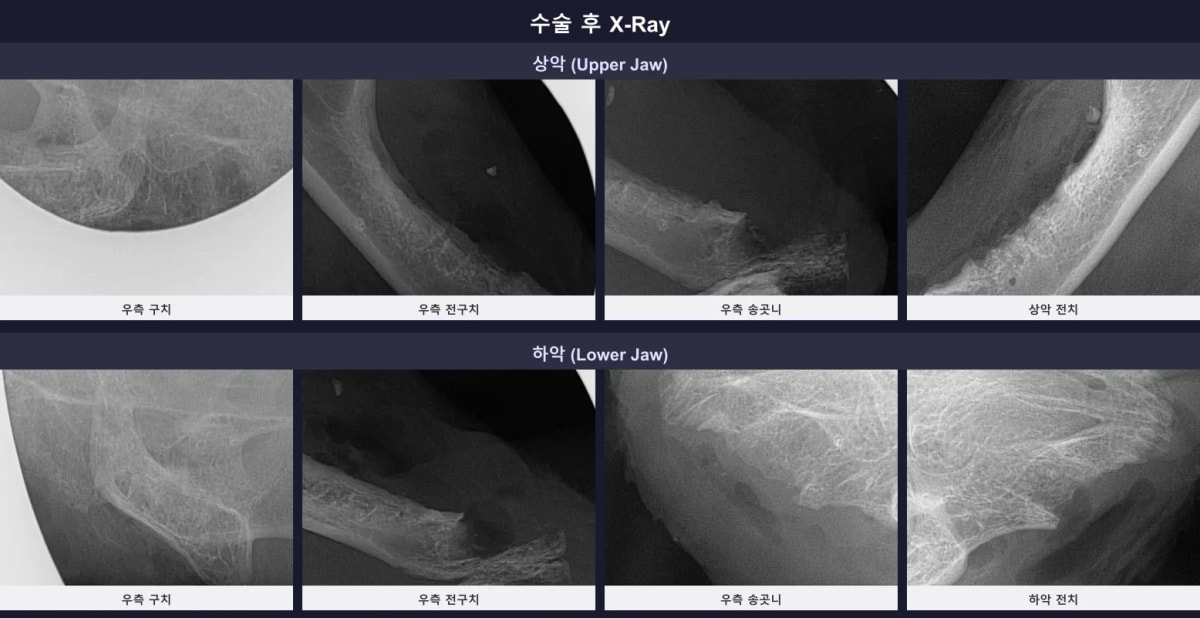 뿌리 하나 남김없이 완벽하게 29개 치아가 발치된 수술 후 구강 엑스레이