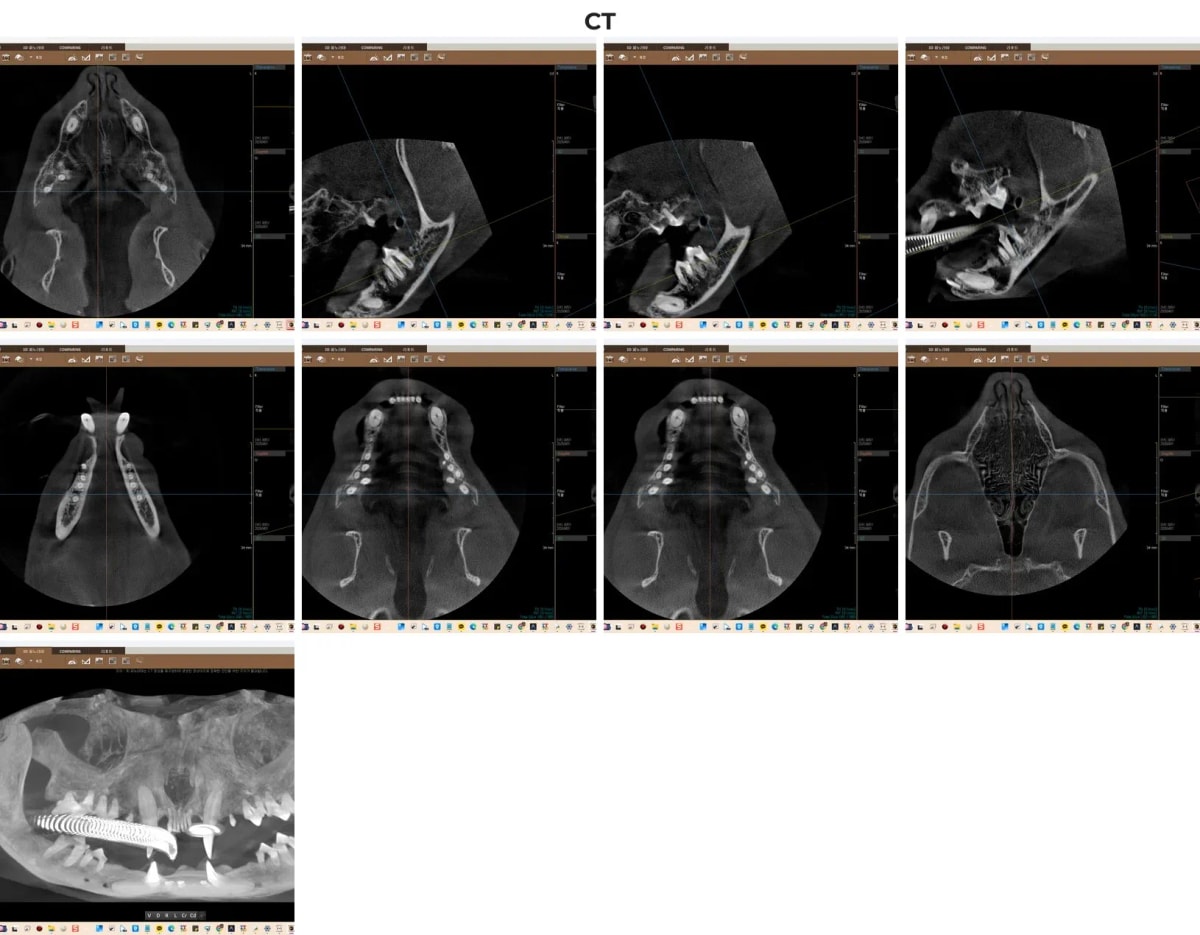 죽순이의 치조골 및 치근 상태를 파악하기 위한 치과 전용 CT 3D 촬영 소견