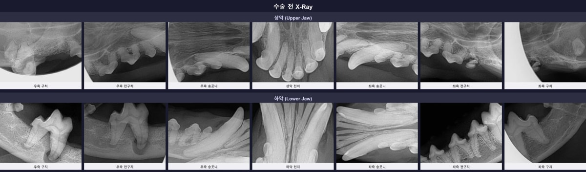 수술 전 하루의 구강 방사선 사진, 심각한 치조골 흡수 및 잔존치근 소견