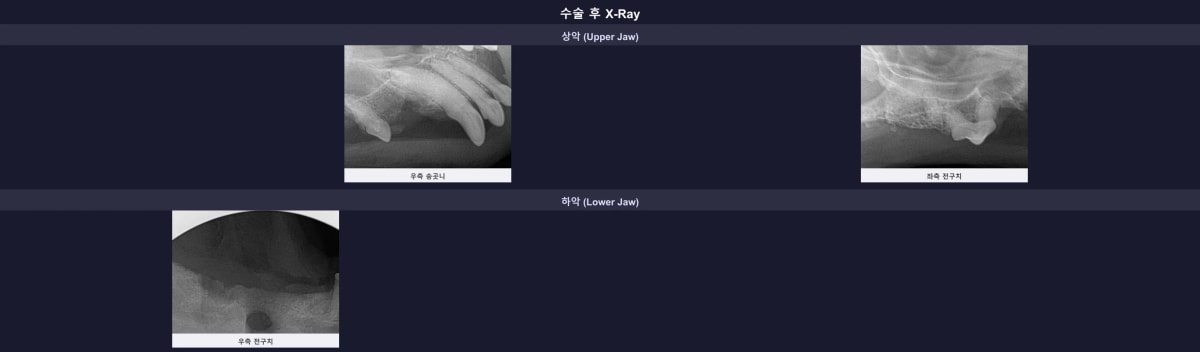 잔존 뿌리 없이 깔끔하게 완료된 발치 부위 및 수술 후 구강 엑스레이