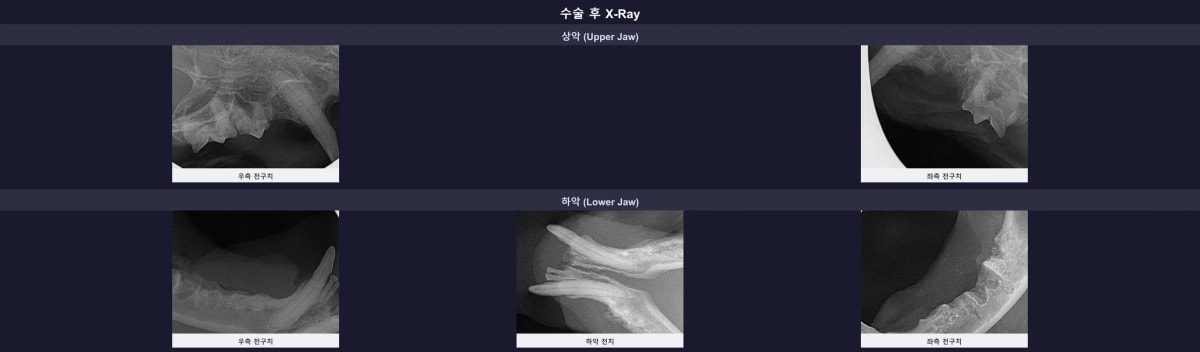 수술 후 잔존 뿌리 없이 완벽히 제거된 구강 엑스레이 영상