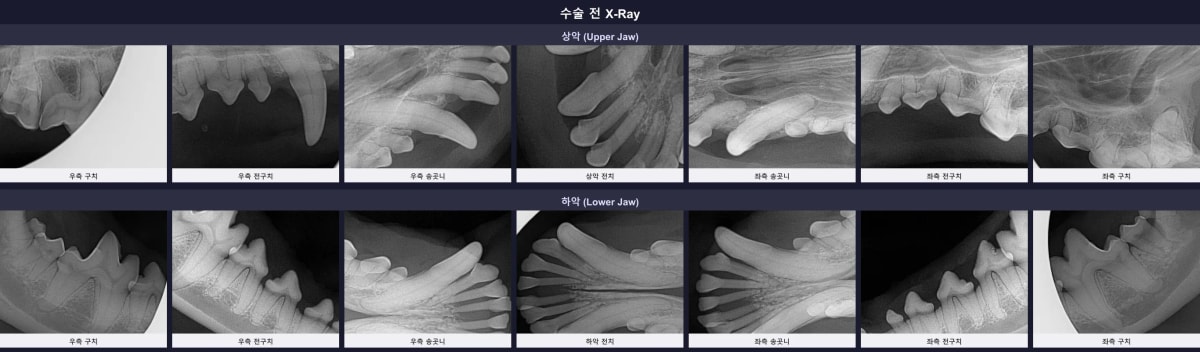 수술 전 치과 방사선 촬영에서 확인된 심한 치조골 흡수와 109번 어금니 뿌리 부러짐