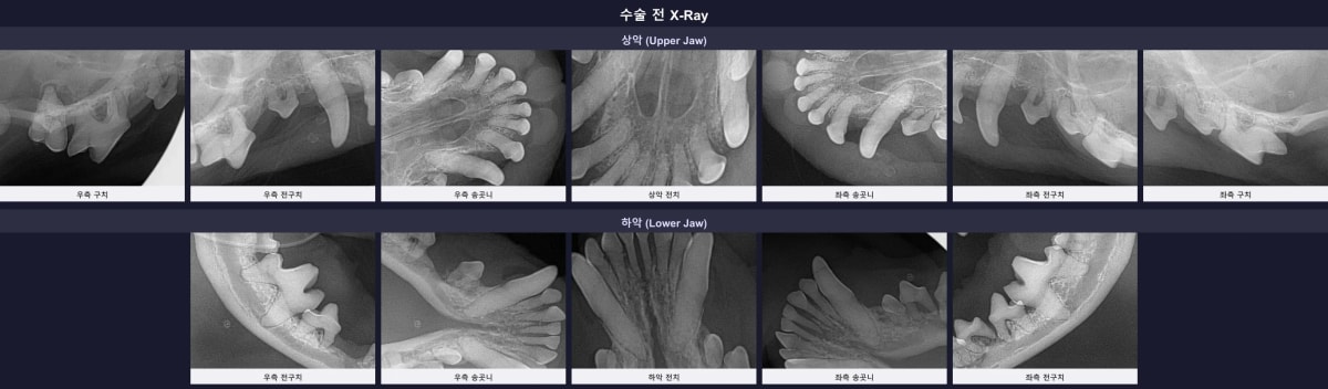 수술 전 치근단 염증과 심각한 치조골 소실을 보여주는 구강 정밀 엑스레이
