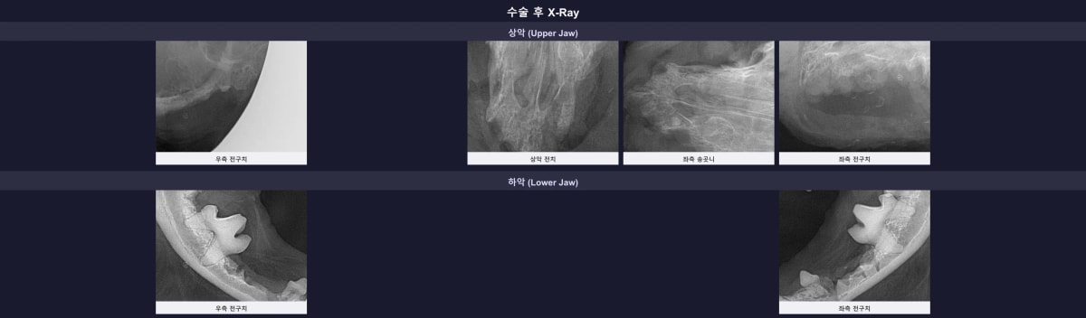 치아 뿌리 잔존 없이 깨끗하게 완료된 수술 후 정밀 엑스레이 소견