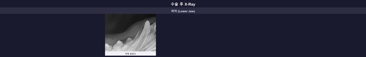 잔존 뿌리 없이 깨끗하게 발치된 수술 후 엑스레이 사진