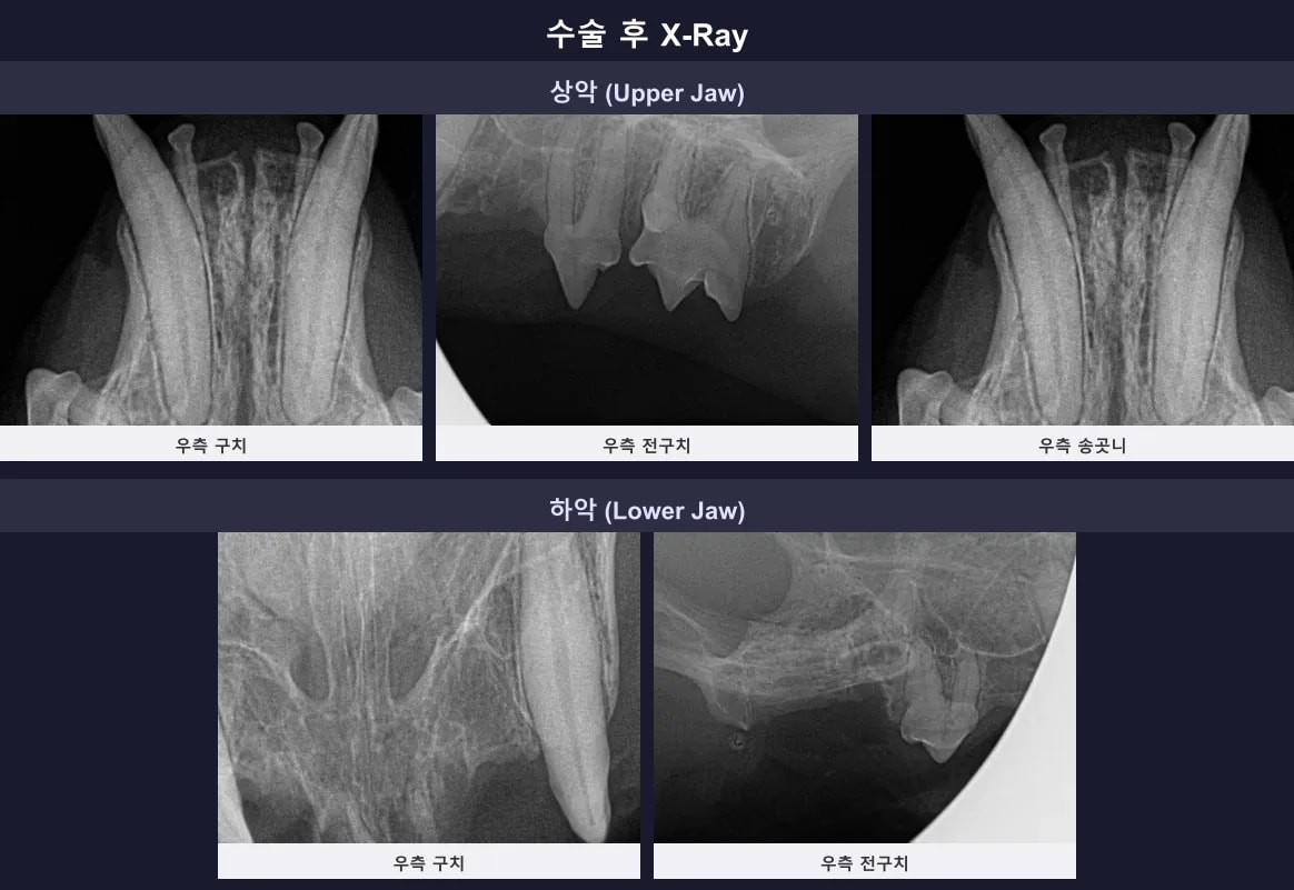 남은 뿌리 없이 깔끔하게 발치가 완료된 수술 후 구강 방사선 사진
