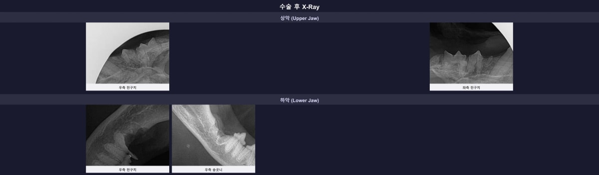 수술 후 말끔해진 구강 방사선 소견