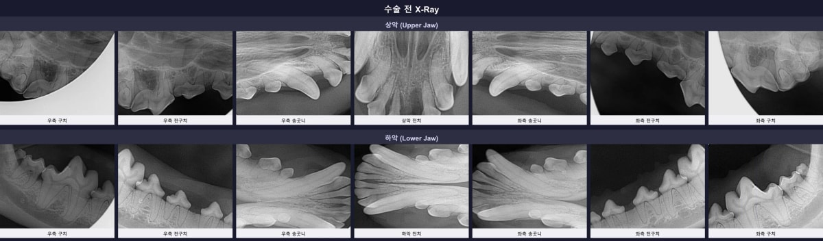 수술 전 치과 방사선 촬영 결과, 잇몸뼈가 소실된 모습