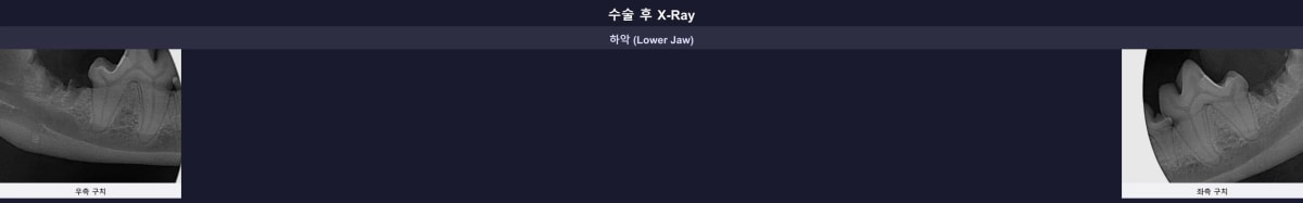 잔존 뿌리 없이 말끔하게 마무리된 수술 후 방사선 사진