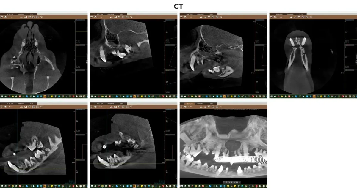 광주 전남 유일 치과 전용 CT를 통해 확인한 우유의 3D 잇몸뼈 흡수 소견