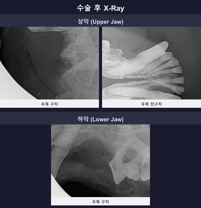 수술 및 발치 완료 후 깨끗해진 구강 방사선(X-ray) 사진