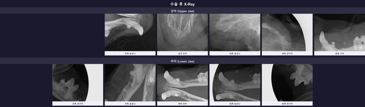 수술 후 잔존 뿌리 없이 깨끗해진 방사선 결과