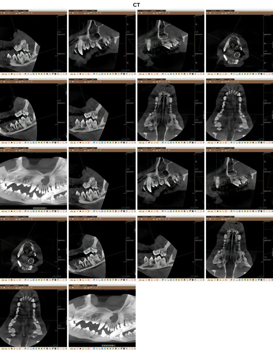 치과 전용 CT를 통한 3차원 정밀 진단 스캔 이미지