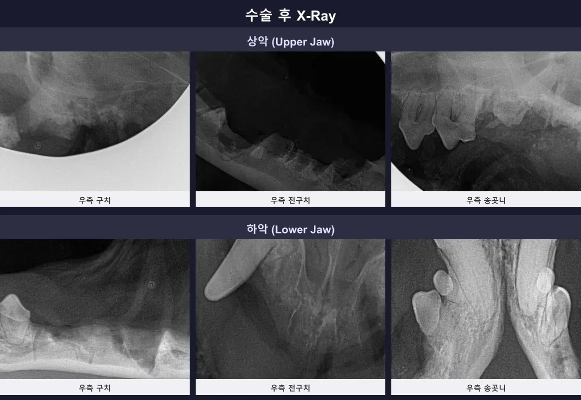 수술 후 남은 잔존 뿌리 없이 깔끔하게 완료된 구강 X-ray 결과