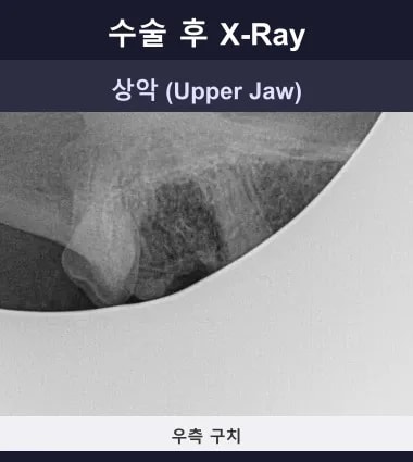 수술 후 구강 엑스레이: 치아 보존 및 치료 부위의 안정적인 모습